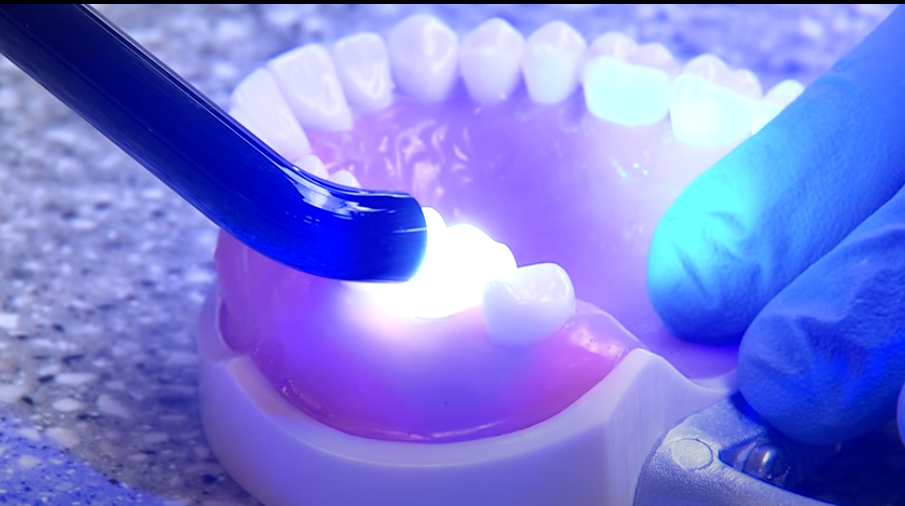 שיטה חדשה לסתימת חורים בשיניים מאפשרת זאת ללא קידוח וללא מילוי